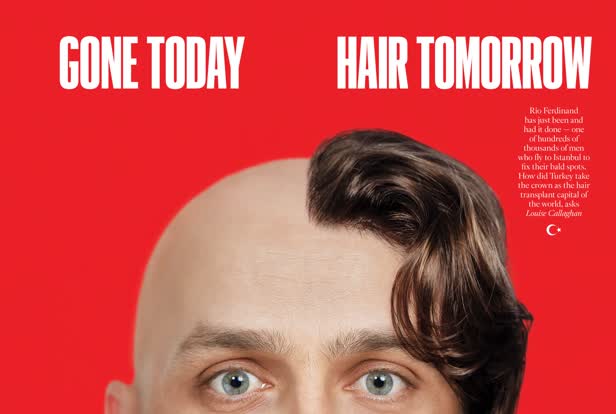Hair Transplant / Sunday Times